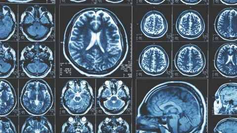 Karbon dioksit uygulaması Alzheimer’la ilişkili proteinlerde geçici değişim sağladı